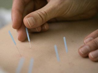 Acupuncture